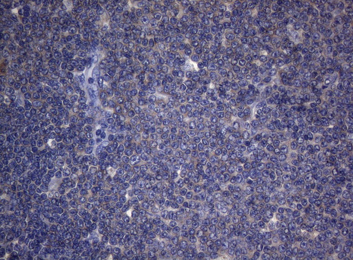 CDCA8 / Borealin Antibody - Immunohistochemical staining of paraffin-embedded Human lymphoma tissue using anti-CDCA8 mouse monoclonal antibody. (Heat-induced epitope retrieval by 1mM EDTA in 10mM Tris buffer. (pH8.5) at 120°C for 3 min. (1:150)
