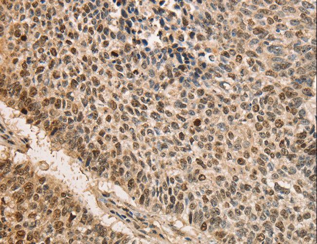 CDCA8 / Borealin Antibody - Immunohistochemistry of paraffin-embedded Human lung cancer using CDCA8 Polyclonal Antibody at dilution of 1:40.