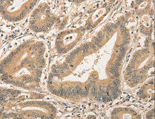 CDCA8 / Borealin Antibody - Immunohistochemistry of paraffin-embedded Human colon cancer using CDCA8 Polyclonal Antibody at dilution of 1:40.