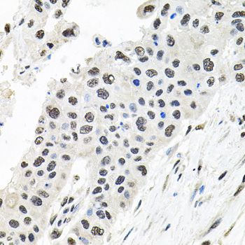 CDCA8 / Borealin Antibody - Immunohistochemistry of paraffin-embedded human lung cancer using CDCA8 antibody at dilution of 1:100 (40x lens).