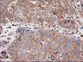 CDCP1 Antibody - IHC of paraffin-embedded Carcinoma of Human bladder tissue using anti-CDCP1 mouse monoclonal antibody. (Heat-induced epitope retrieval by 10mM citric buffer, pH6.0, 100C for 10min).