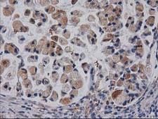 CDCP1 Antibody - IHC of paraffin-embedded Adenocarcinoma of Human colon tissue using anti-CDCP1 mouse monoclonal antibody. (Heat-induced epitope retrieval by 10mM citric buffer, pH6.0, 100C for 10min).