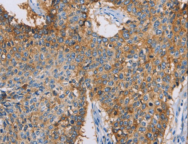 CDCP1 Antibody - Immunohistochemistry of paraffin-embedded Human lung cancer using CDCP1 Polyclonal Antibody at dilution of 1:50.