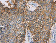 CDCP1 Antibody - Immunohistochemistry of paraffin-embedded Human lung cancer using CDCP1 Polyclonal Antibody at dilution of 1:50.