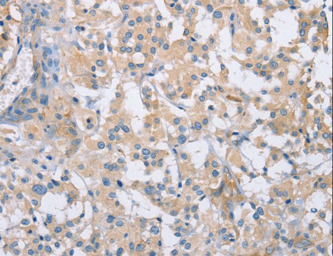 CDCP1 Antibody - Immunohistochemistry of paraffin-embedded Human thyroid cancer using CDCP1 Polyclonal Antibody at dilution of 1:50.