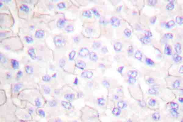 CDH1 / E Cadherin Antibody - IHC of E-cadherin (R868) pAb in paraffin-embedded human breast carcinoma tissue.