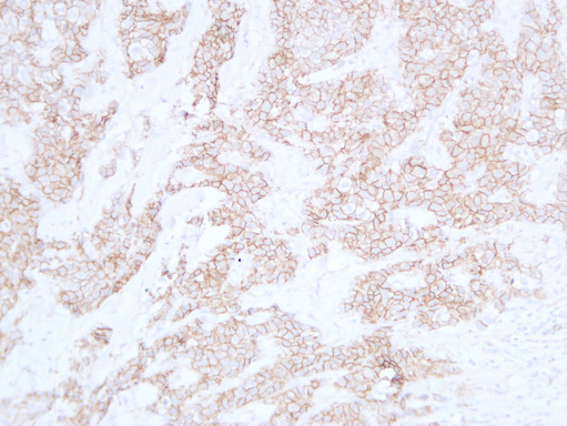 CDH1 / E Cadherin Antibody - Breast Carcinoma 1
