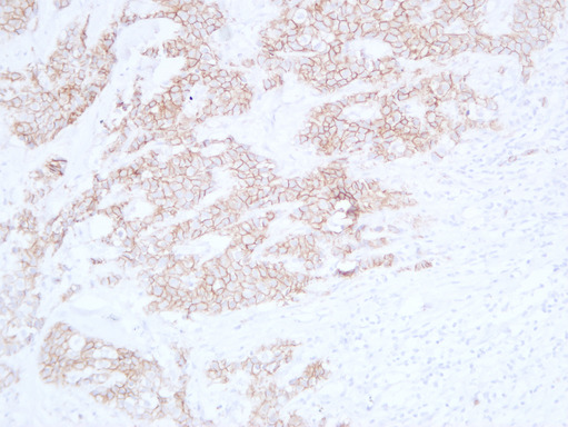 CDH1 / E Cadherin Antibody - Breast Carcinoma 2