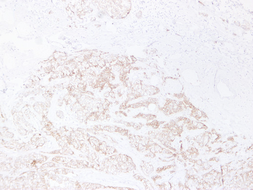 CDH1 / E Cadherin Antibody - Breast Carcinoma 3