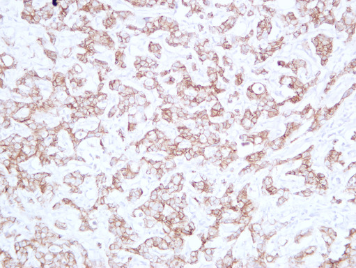 CDH1 / E Cadherin Antibody - Breast Carcinoma 4