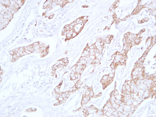 CDH1 / E Cadherin Antibody - Breast Carcinoma 5