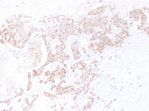 CDH1 / E Cadherin Antibody - Breast Carcinoma 6