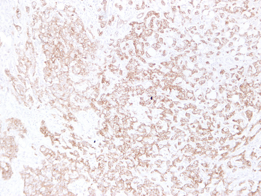 CDH1 / E Cadherin Antibody - Breast Carcinoma 7