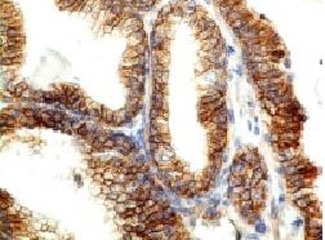 CDH1 / E Cadherin Antibody - Formalin-fixed, paraffin-embedded human colon carcinoma stained with E-Cadherin antibody (CDH1/1525).