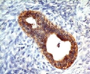 CDH1 / E Cadherin Antibody - Formalin-fixed, paraffin-embedded human colon carcinoma stained with E-Cadherin antibody (CDH1/1525).
