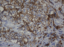 CDH1 / E Cadherin Antibody - IHC of paraffin-embedded Adenocarcinoma of Human colon tissue using anti-CDH1 mouse monoclonal antibody. (Heat-induced epitope retrieval by 10mM citric buffer, pH6.0, 120°C for 3min).