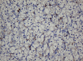 CDH1 / E Cadherin Antibody - IHC of paraffin-embedded Carcinoma of Human kidney tissue using anti-CDH1 mouse monoclonal antibody. (Heat-induced epitope retrieval by 10mM citric buffer, pH6.0, 120°C for 3min).