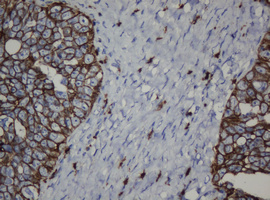 CDH1 / E Cadherin Antibody - IHC of paraffin-embedded Adenocarcinoma of Human ovary tissue using anti-CDH1 mouse monoclonal antibody. (Heat-induced epitope retrieval by 10mM citric buffer, pH6.0, 120°C for 3min).