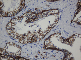 CDH1 / E Cadherin Antibody - IHC of paraffin-embedded Carcinoma of Human prostate tissue using anti-CDH1 mouse monoclonal antibody. (Heat-induced epitope retrieval by 10mM citric buffer, pH6.0, 120°C for 3min).
