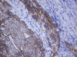 CDH1 / E Cadherin Antibody - IHC of paraffin-embedded Adenocarcinoma of Human breast tissue using anti-CDH1 mouse monoclonal antibody.