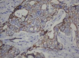 CDH1 / E Cadherin Antibody - IHC of paraffin-embedded Adenocarcinoma of Human breast tissue using anti-CDH1 mouse monoclonal antibody. (Heat-induced epitope retrieval by 10mM citric buffer, pH6.0, 120°C for 3min).