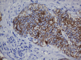 CDH1 / E Cadherin Antibody - IHC of paraffin-embedded Adenocarcinoma of Human colon tissue using anti-CDH1 mouse monoclonal antibody. (Heat-induced epitope retrieval by 10mM citric buffer, pH6.0, 120°C for 3min).
