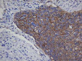 CDH1 / E Cadherin Antibody - IHC of paraffin-embedded Carcinoma of Human lung tissue using anti-CDH1 mouse monoclonal antibody. (Heat-induced epitope retrieval by 10mM citric buffer, pH6.0, 120°C for 3min).