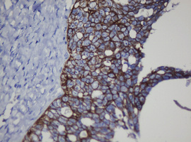 CDH1 / E Cadherin Antibody - IHC of paraffin-embedded Adenocarcinoma of Human ovary tissue using anti-CDH1 mouse monoclonal antibody. (Heat-induced epitope retrieval by 10mM citric buffer, pH6.0, 120°C for 3min).