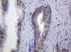 CDH1 / E Cadherin Antibody - IHC of paraffin-embedded Carcinoma of Human prostate tissue using anti-CDH1 mouse monoclonal antibody.