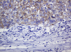 CDH1 / E Cadherin Antibody - IHC of paraffin-embedded Adenocarcinoma of Human colon tissue using anti-CDH1 mouse monoclonal antibody.