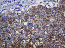 CDH1 / E Cadherin Antibody - IHC of paraffin-embedded Adenocarcinoma of Human colon tissue using anti-CDH1 mouse monoclonal antibody.