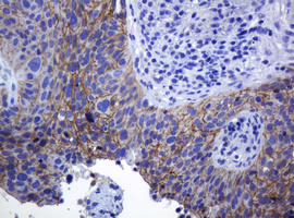 CDH1 / E Cadherin Antibody - IHC of paraffin-embedded Carcinoma of Human lung tissue using anti-CDH1 mouse monoclonal antibody.