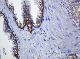 CDH1 / E Cadherin Antibody - IHC of paraffin-embedded Carcinoma of Human prostate tissue using anti-CDH1 mouse monoclonal antibody.