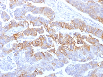 CDH1 / E Cadherin Antibody - Formalin-fixed, paraffin-embedded human Colon Carcinoma stained with E-Cadherin Mouse Recombinant Monoclonal Antibody (rCDH1/1525).