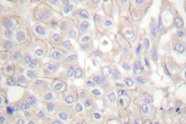 CDH1 / E Cadherin Antibody - IHC of E-cadherin (G2) pAb in paraffin-embedded human breast carcinoma tissue.