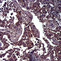 CDH1 / E Cadherin Antibody - Immunohistochemical analysis of E Cadherin staining in human lung cancer formalin fixed paraffin embedded tissue section. The section was pre-treated using heat mediated antigen retrieval with sodium citrate buffer (pH 6.0). The section was then incubated with the antibody at room temperature and detected using an HRP conjugated compact polymer system. DAB was used as the chromogen. The section was then counterstained with hematoxylin and mounted with DPX.