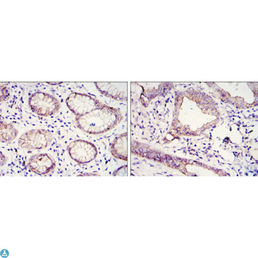 CDH1 / E Cadherin Antibody - Immunohistochemistry (IHC) analysis of paraffin-embedded gastric cancer tissues (left) and Lung Cancer Tissues (right) with DAB staining using E-cadherin Monoclonal Antibody.