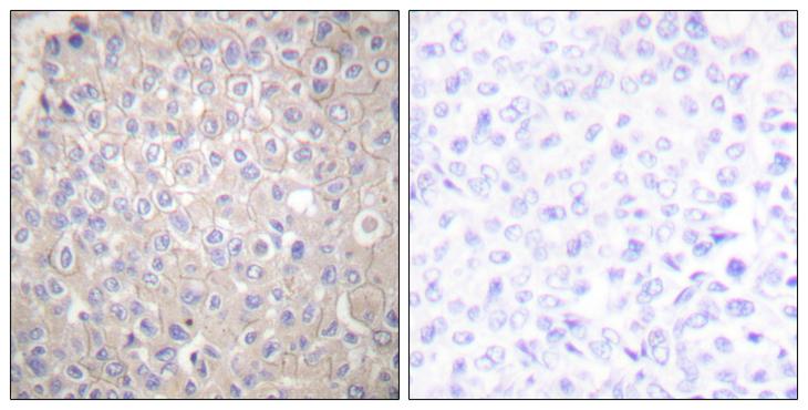 CDH1 / E Cadherin Antibody - Peptide - + Immunohistochemical analysis of paraffin-embedded human breast carcinoma tissue using E-cadherin antibody.