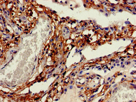 CDH11 / Cadherin 11 Antibody - Immunohistochemistry of paraffin-embedded human lung cancer at dilution of 1:100