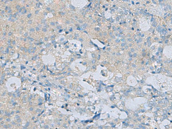 CDH12 / Cadherin 12 Antibody - Immunohistochemistry of paraffin-embedded Human ovarian cancer tissue  using CDH12 Polyclonal Antibody at dilution of 1:60(×200)