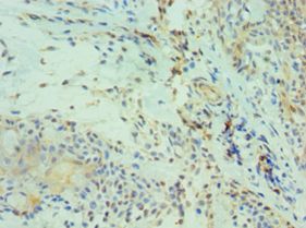 CDH13 / Cadherin 13 Antibody - Immunohistochemistry of paraffin-embedded human breast cancer using antibody at 1:100 dilution.