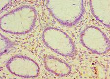 CDH16 / Cadherin 16 Antibody - Immunohistochemistry of paraffin-embedded human colon cancer using antibody at 1:100 dilution.