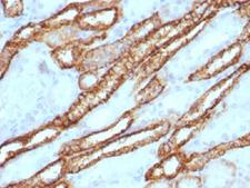 CDH16 / Cadherin 16 Antibody - IHC testing of FFPE human renal cell carcinoma with Cadherin 16 antibody. Required HIER: steam sections in 10mM Tris with 1mM EDTA, pH 9, for 10-20 min.