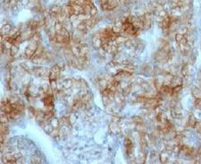 CDH16 / Cadherin 16 Antibody - Formalin-fixed, paraffin-embedded human renal cell carcinoma stained with Cadherin 16 antibody (CDH16/1071).  This image was taken for the unmodified form of this product. Other forms have not been tested.