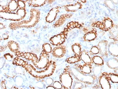 CDH16 / Cadherin 16 Antibody - Formalin-fixed, paraffin-embedded Human Renal Cell Carcinoma stained with KSP-Cadherin Rabbit Recombinant Monoclonal Antibody (CDH16/1532R)