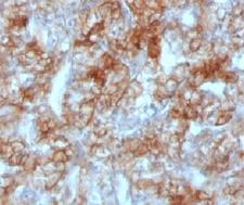 CDH16 / Cadherin 16 Antibody - IHC testing of FFPE human renal cell carcinoma and Cadherin 16 antibody (clone KSCP2).  This image was taken for the unmodified form of this product. Other forms have not been tested.