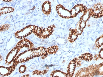 CDH16 / Cadherin 16 Antibody - Formalin-fixed, paraffin-embedded Human Renal Cell Carcinoma stained with KSP-Cadherin Recombinant Mouse Monoclonal Antibody (rCDH16/1071).