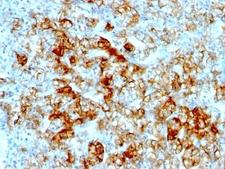 CDH16 / Cadherin 16 Antibody - Formalin-fixed, paraffin-embedded human renal cell carcinoma stained with anti-Cadherin 16 antibody (SPM594).  This image was taken for the unmodified form of this product. Other forms have not been tested.