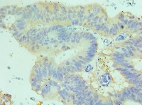 CDH17 / Cadherin 17 Antibody - Immunohistochemistry of paraffin-embedded human colon cancer using antibody at 1:100 dilution.