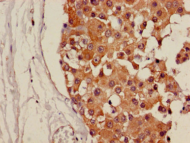 CDH18 / Ey-Cadherin Antibody - Immunohistochemistry image of paraffin-embedded human breast cancer at a dilution of 1:100